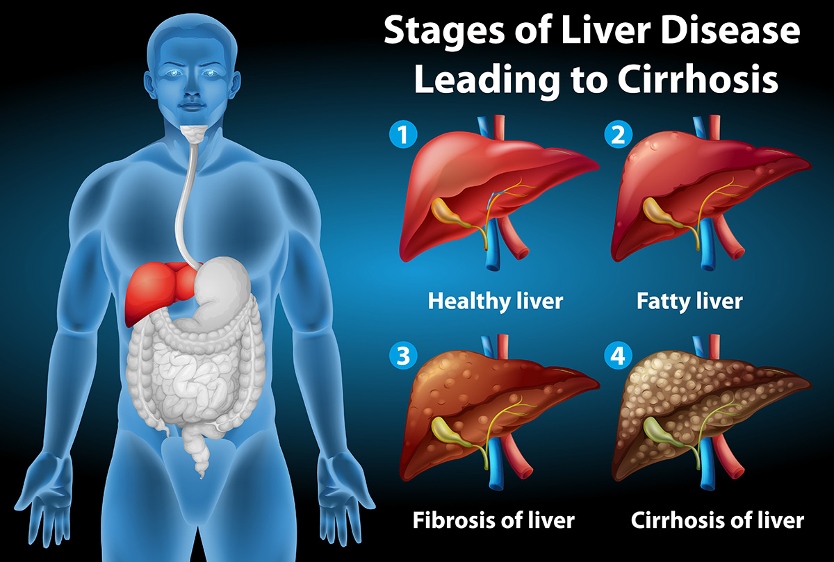 What Is Non Alcoholic Fatty Liver Disease 